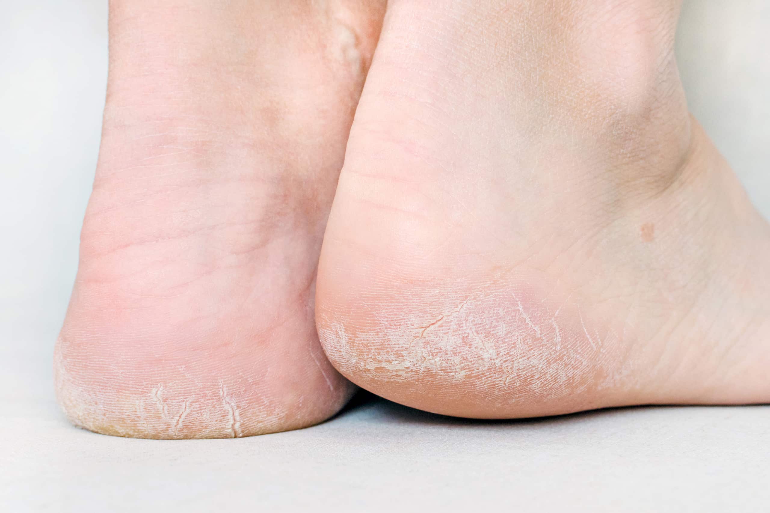 Hard Skin - Waverley Clinic